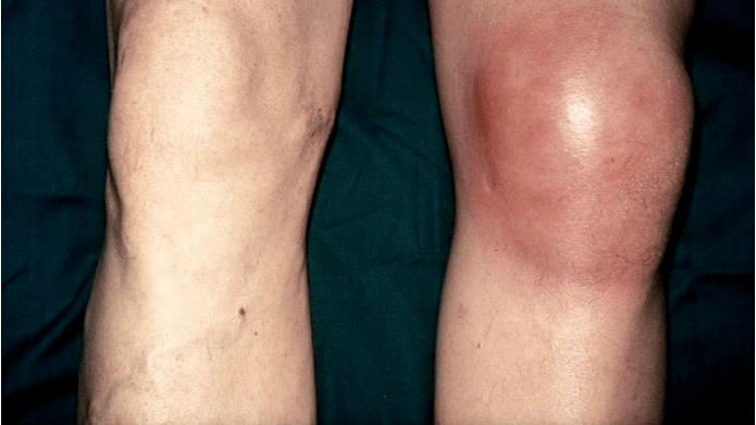 Arthros and arthritis