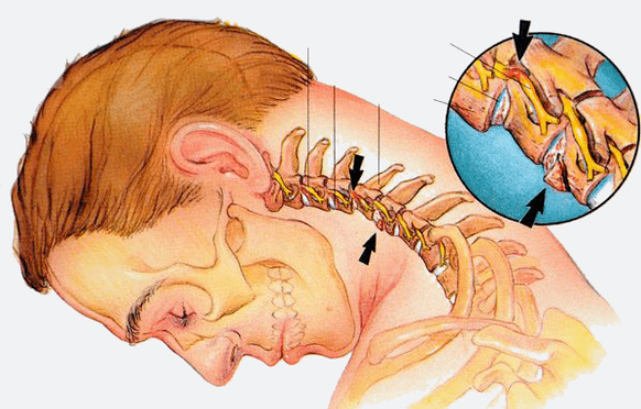 Stages of osteocondrosis of the cervical spine